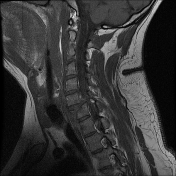 File:Cervical fracture and dislocation with locked facet (Radiopaedia 31837-32781 Sagittal T1 5).jpg