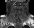 Cervical schwannoma (Radiopaedia 72399-82934 G 11).jpg