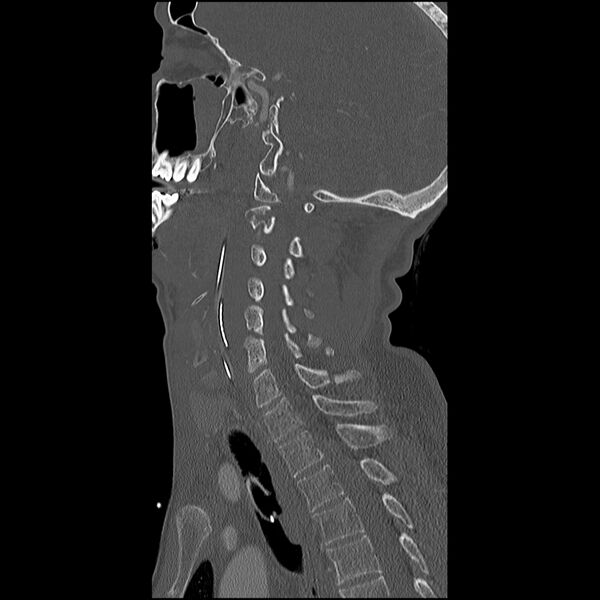 File:Cervical spine fractures with vertebral artery dissection (Radiopaedia 32135-33078 Sagittal bone window 15).jpg