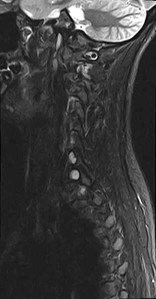 File:Cervical spondylodiscitis and calvarial hemangioma (Radiopaedia 64317-73104 Sagittal STIR 2).jpg