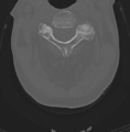 Cervical spondylolysis (Radiopaedia 49616-54811 Axial bone window 19).png
