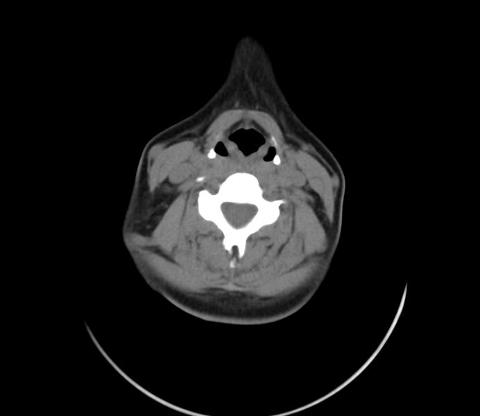 File:Cervical venous malformation (Radiopaedia 22653-22672 Axial non-contrast 34).jpg