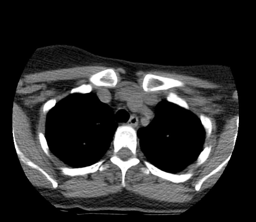 Cervical venous malformation (Radiopaedia 22653-22672 Axial non-contrast 56).jpg