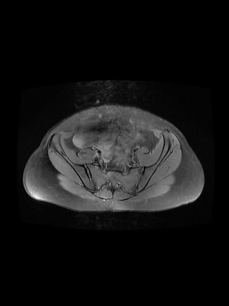 File:Cesarean section scar endometrioma (Radiopaedia 56569-63297 Axial PD fat sat 12).jpg