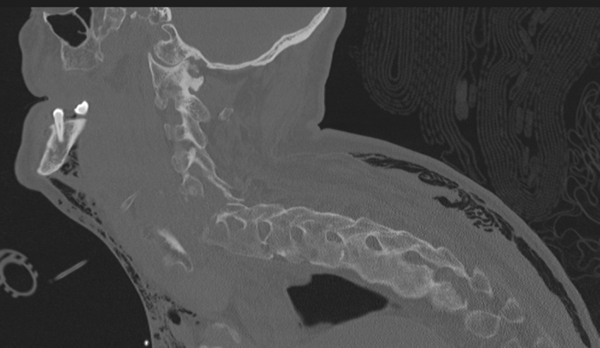 Chalk stick fracture (Radiopaedia 57948-64928 Sagittal bone window 21).png