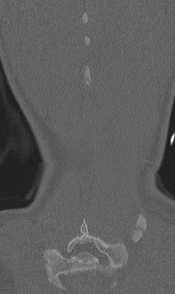 File:Chance fracture (Radiopaedia 40360-42912 Coronal bone window 66).png