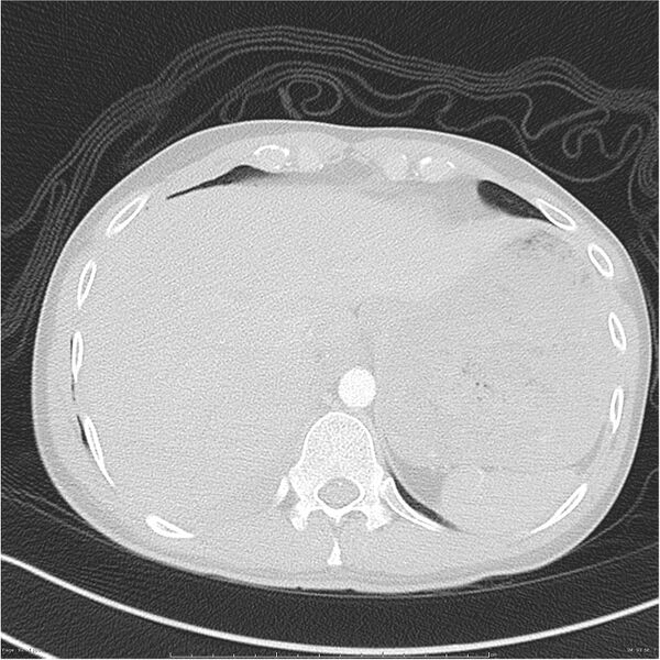 File:Chest and abdomen multi-trauma (Radiopaedia 26294-26425 lung window 92).jpg
