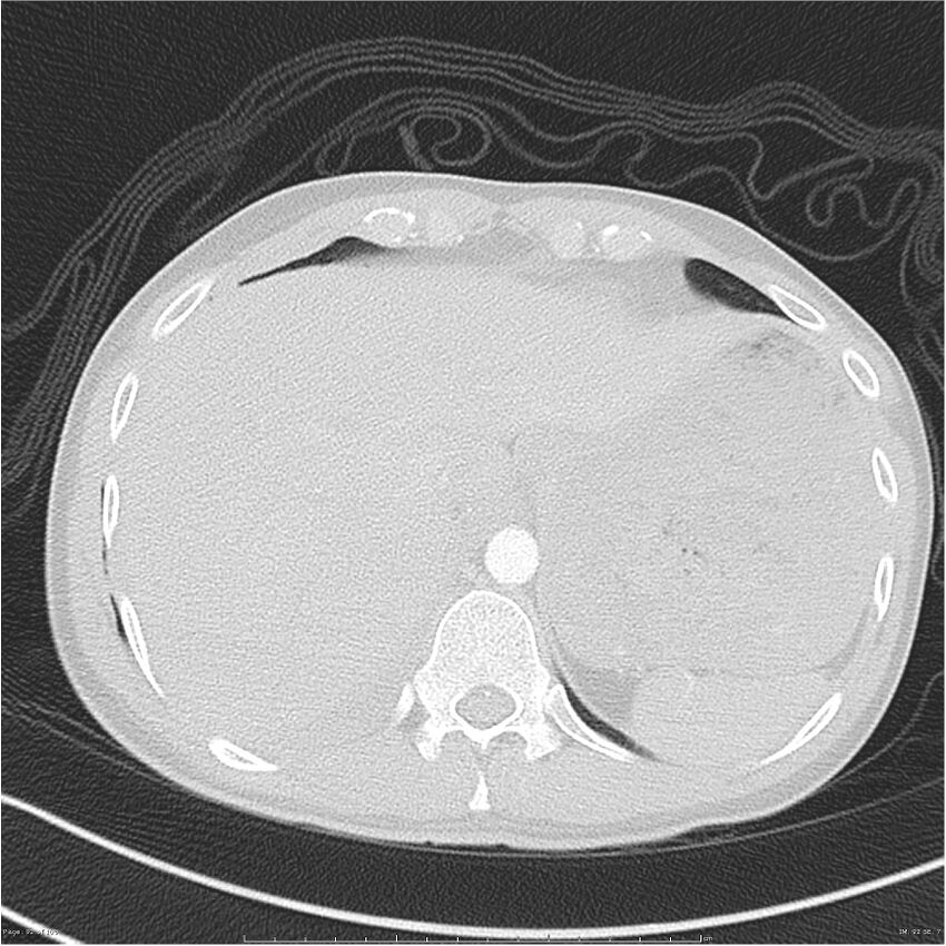 Chest and abdomen multi-trauma (Radiopaedia 26294-26425 lung window 92).jpg