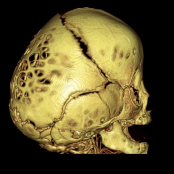File:Chiari I and severe copper beaten skull (Radiopaedia 5993-7504 C 1).jpg