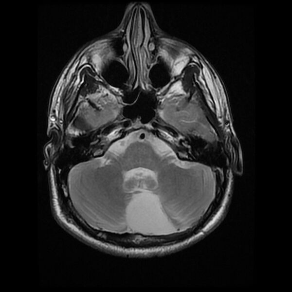 File:Chiasmatic-hypothalamic juvenile pilocytic astrocytoma (Radiopaedia 78533-91235 Axial T2 8).jpg