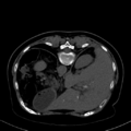 Cholecystitis - CT IVC obstructive choledocholitiasis (Radiopaedia 43966-47479 Axial Biliscopin 33).png