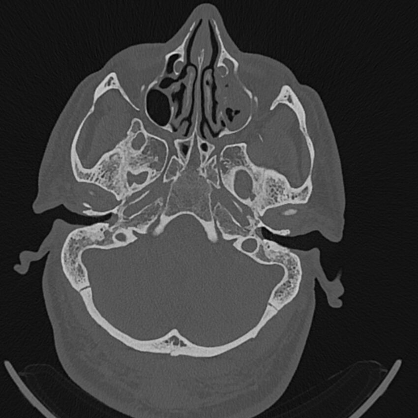 Cholesteatoma (Radiopaedia 68176-77673 Axial bone window 24).jpg