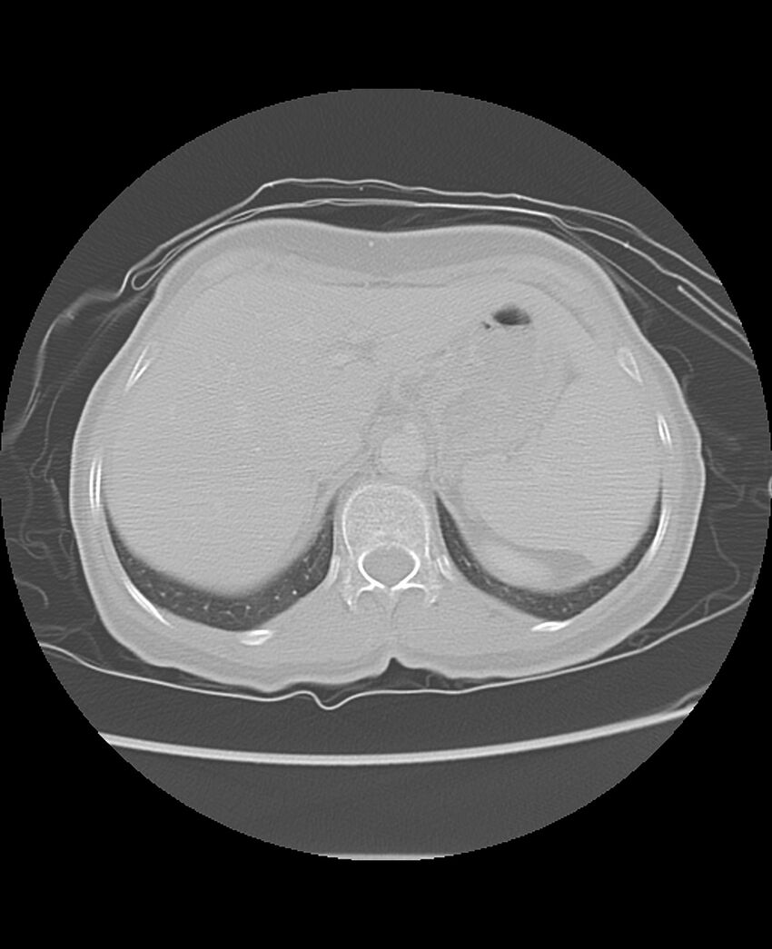 Chondrosarcoma (Radiopaedia 79427-92532 Axial lung window 53).jpg