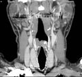 Chondrosarcoma - larynx (Radiopaedia 4588-6698 B 2).jpg