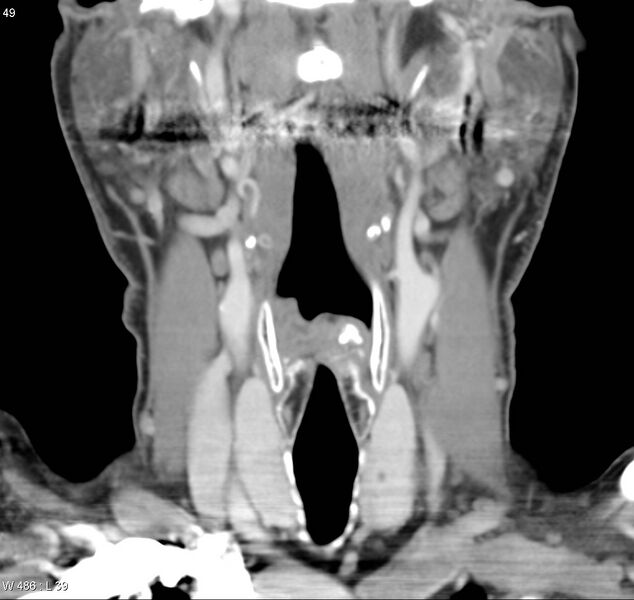 File:Chondrosarcoma - larynx (Radiopaedia 4588-6698 B 2).jpg