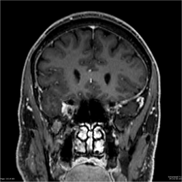 File:Chondrosarcoma of skull base- grade II (Radiopaedia 40948-43654 Coronal T1 C+ 43).jpg