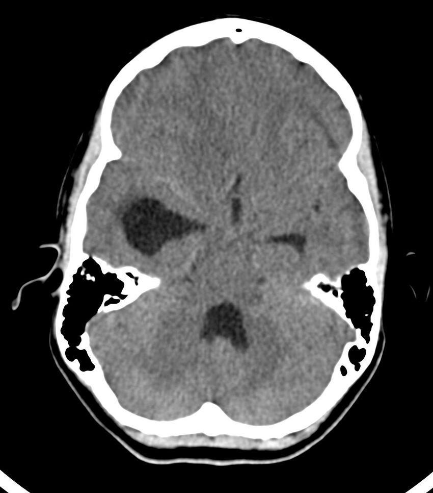 Choroid plexus carcinoma (Radiopaedia 91013-108552 Axial non-contrast 21).jpg