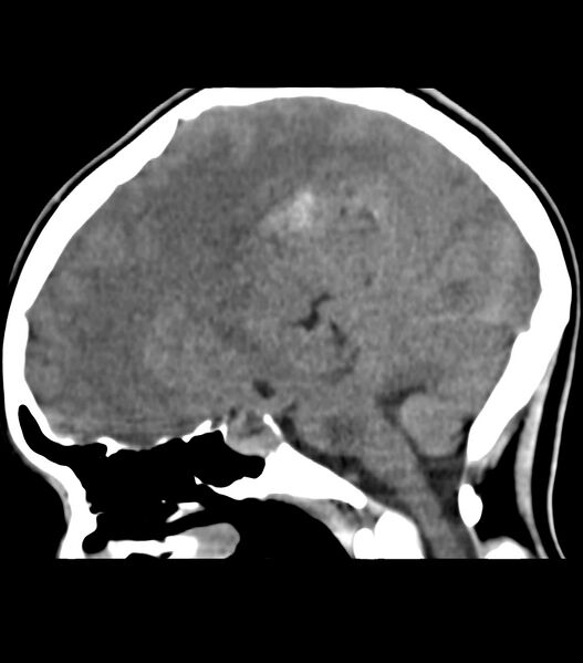 File:Choroid plexus carcinoma (Radiopaedia 91013-108552 B 41).jpg