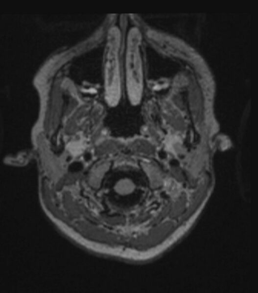 File:Choroid plexus carcinoma (Radiopaedia 91013-108553 Axial FLAIR C+ 70).jpg