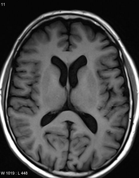 File:Chronic lymphocytic inflammation with pontine perivascular enhancement responsive to steroids (CLIPPERS) (Radiopaedia 37520-39374 Axial T1 10).jpg