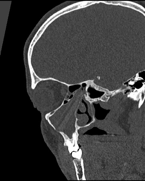 File:Chronic maxillary sinusitis caused by a foreign body (Radiopaedia 58521-65676 Sagittal bone window 22).jpg