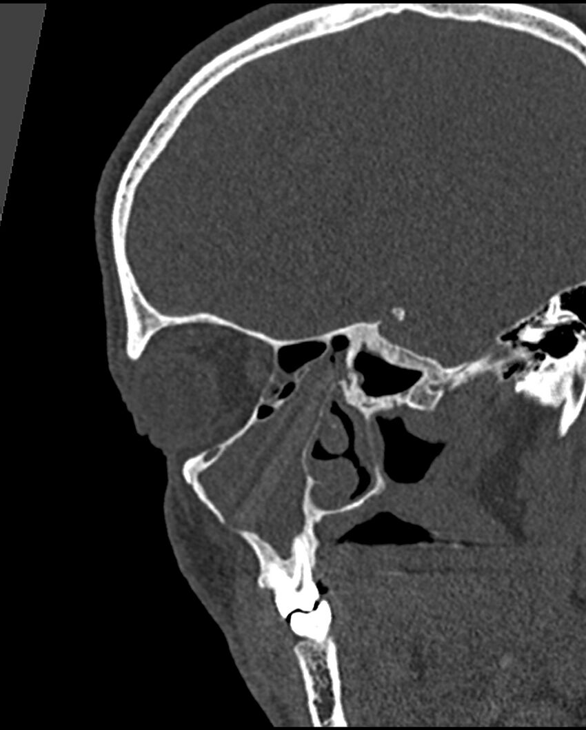 Chronic maxillary sinusitis caused by a foreign body (Radiopaedia 58521-65676 Sagittal bone window 22).jpg