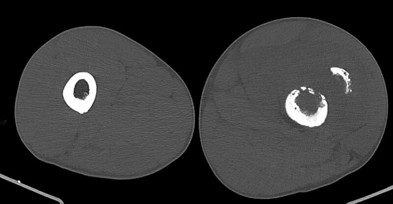 File:Chronic osteomyelitis (with sequestrum) (Radiopaedia 74813-85822 Axial non-contrast 89).jpg