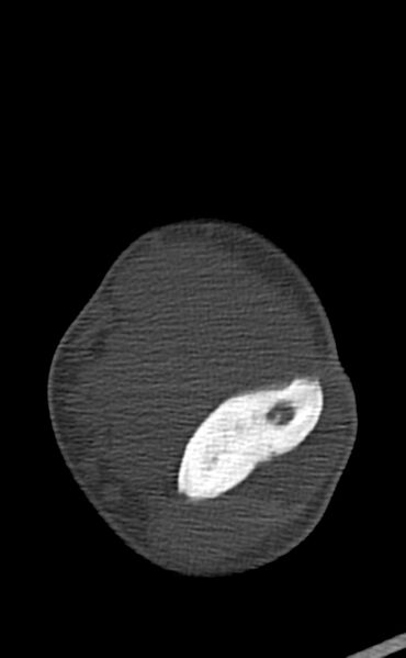 File:Chronic osteomyelitis of the distal humerus (Radiopaedia 78351-90971 Axial bone window 78).jpg