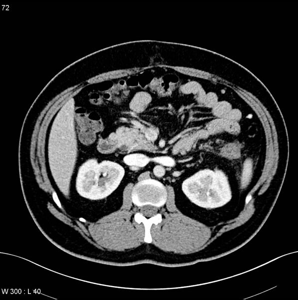 File:Chronic pancreatitis and pseudocysts (Radiopaedia 6724-7935 B 13).jpg