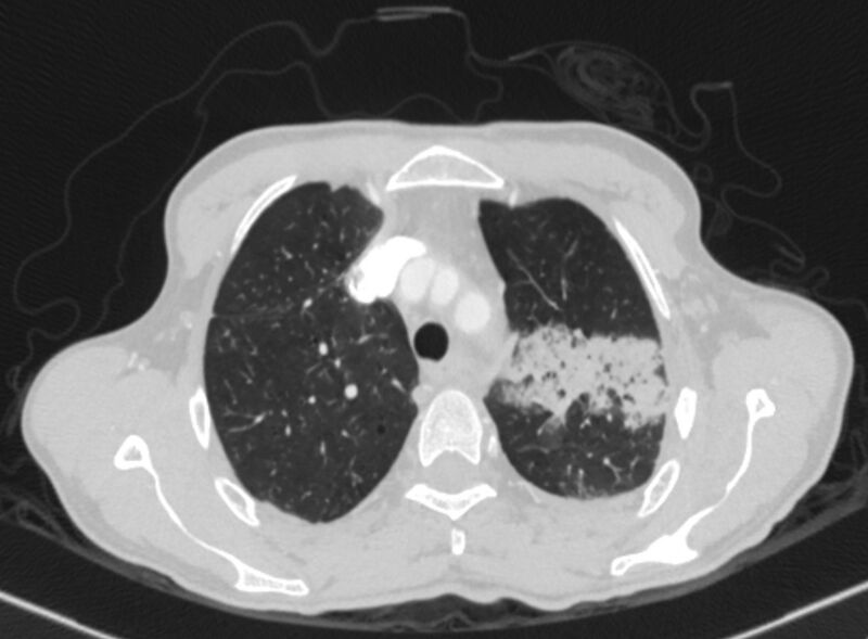 File:Chronic pulmonary embolism with bubbly consolidation (Radiopaedia 91248-108850 Axial lung window 34).jpg