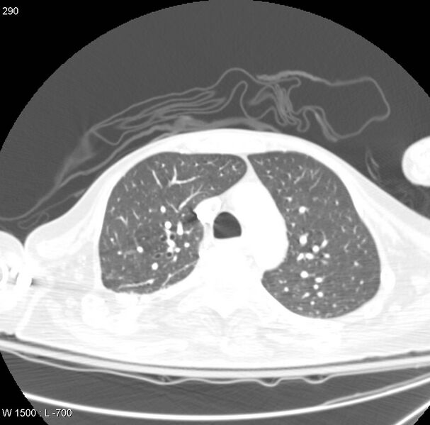File:Clagett thoracotomy (Radiopaedia 8568-9403 Axial lung window 13).jpg