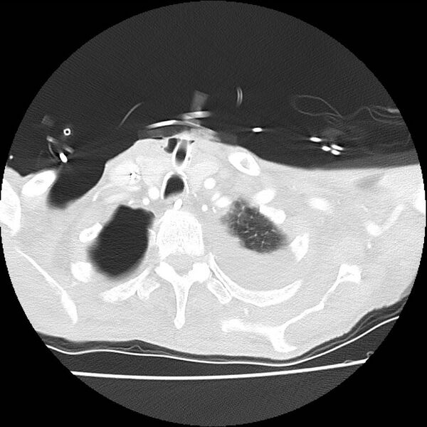 File:Clagett thoracotomy with bronchopleural fistula (Radiopaedia 29192-29587 Axial lung window 2).jpg