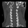 Clay-shoveler fracture (Radiopaedia 22568-22590 Coronal bone window 16).jpg