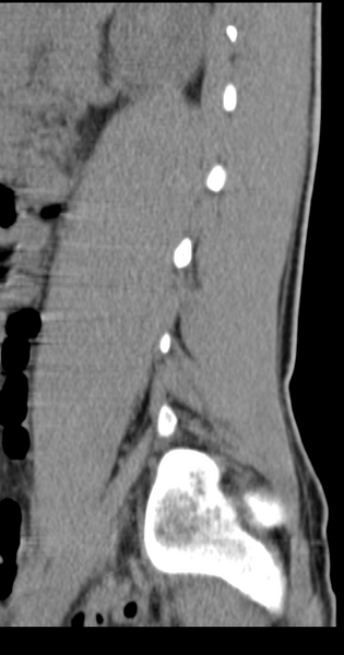 File:Clear cell meningoma - lumbar spine (Radiopaedia 60116-67691 A 10).png