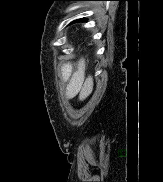 File:Closed-loop small bowel obstruction-internal hernia (Radiopaedia 78439-91096 C 21).jpg