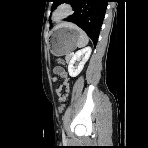 File:Co-existing acute appendicitis and epiploic appendagitis (Radiopaedia 61789-69911 B 71).jpg