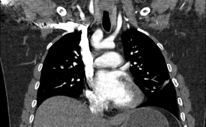 File:Coarctation of the aorta (Radiopaedia 53363-59343 C 31).jpg