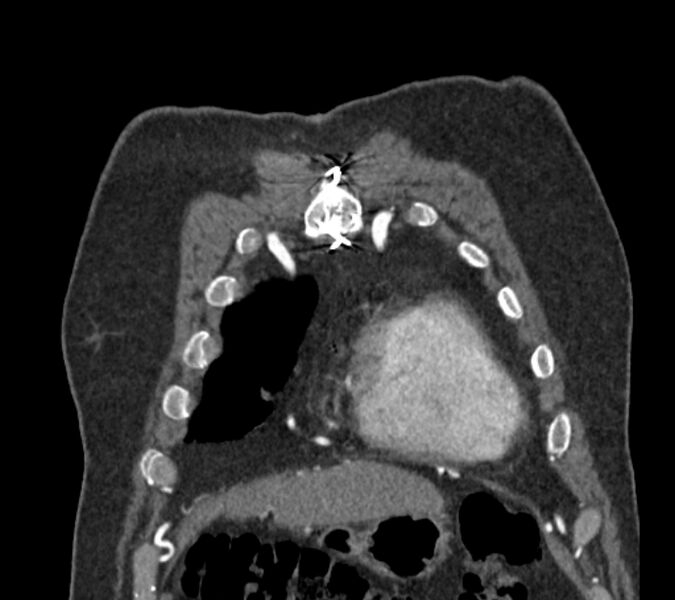 File:Coarctation of the aorta (Radiopaedia 53752-59822 B 14).jpg