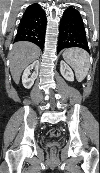 File:Coarctation of the aorta (Radiopaedia 74632-88521 B 174).jpg