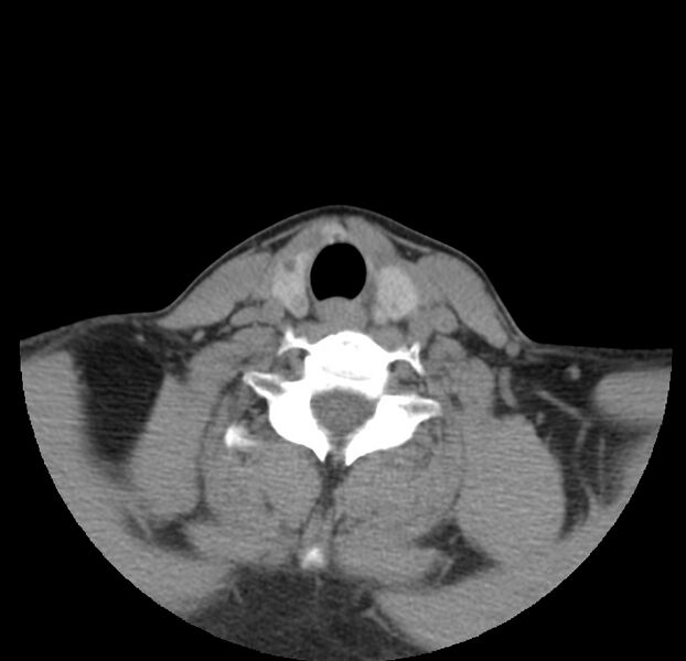 File:Colloid cyst of thyroid (Radiopaedia 22897-22923 Axial non-contrast 39).jpg