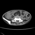 Colocolic fistula - Crohn disease (Radiopaedia 57063-63955 A 54).jpg