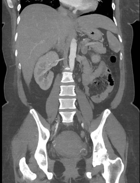 File:Colonic pseudo-obstruction (Radiopaedia 79752-92980 B 38).png