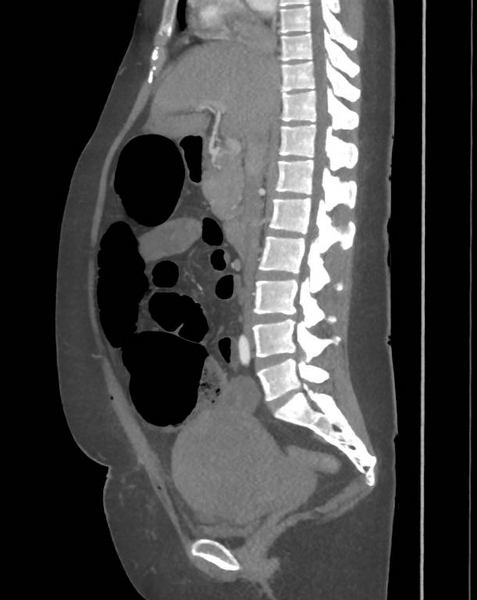 File:Colonic pseudo-obstruction (Radiopaedia 79752-92980 C 37).png