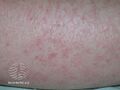 Eczema craquelé (DermNet NZ dermatitis-eczema-craquele1).jpg