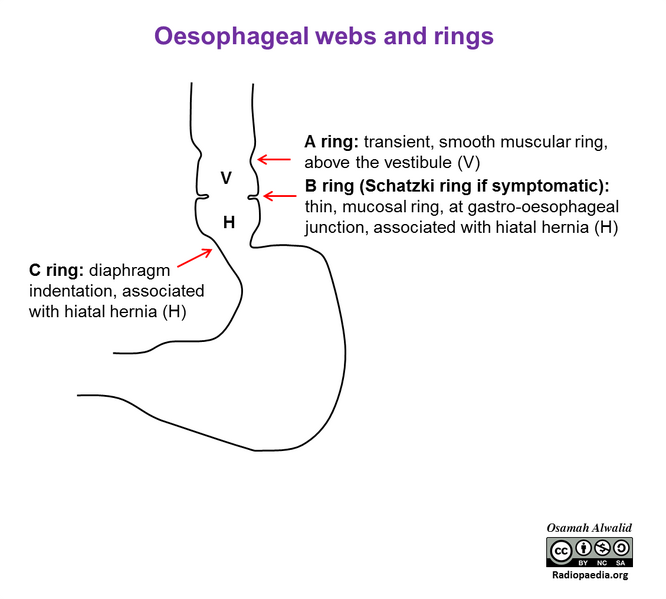 File:Esophageal webs and rings (illustration) (Radiopaedia 84007).png