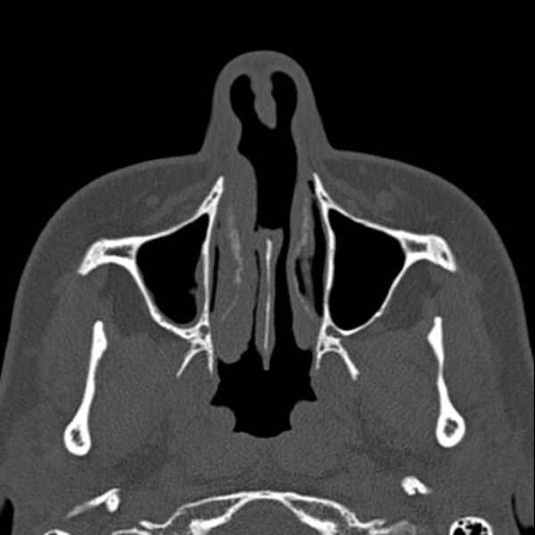 File:Nasal septal perforation (Radiopaedia 25030-25289 Axial bone window 11).jpg