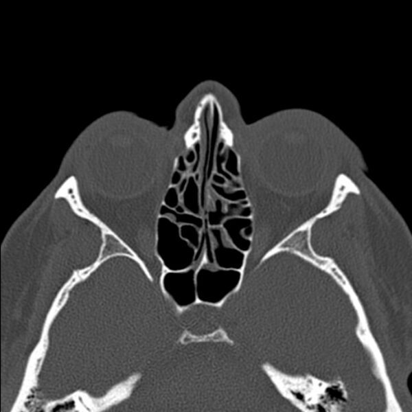 File:Nasal septal perforation (Radiopaedia 25030-25289 Axial bone window 38).jpg