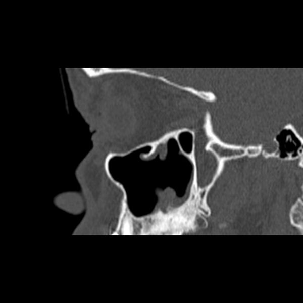 File:Nasal septal perforation (Radiopaedia 25030-25289 Sagittal bone window 3).jpg