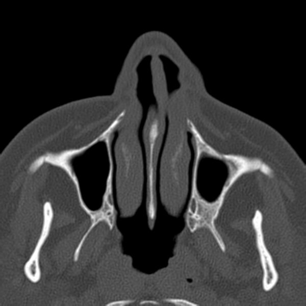 File:Nasolabial cyst (Radiopaedia 33987-35205 Axial bone window 11).jpg