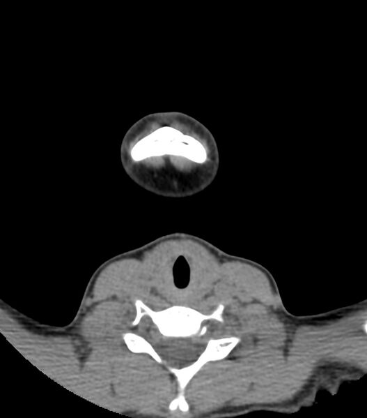 File:Nasoorbitoethmoid fracture (Radiopaedia 90044-107205 Axial non-contrast 17).jpg